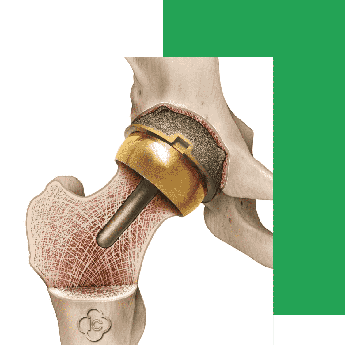 Hip Replacement Surgery Expert Surgeries