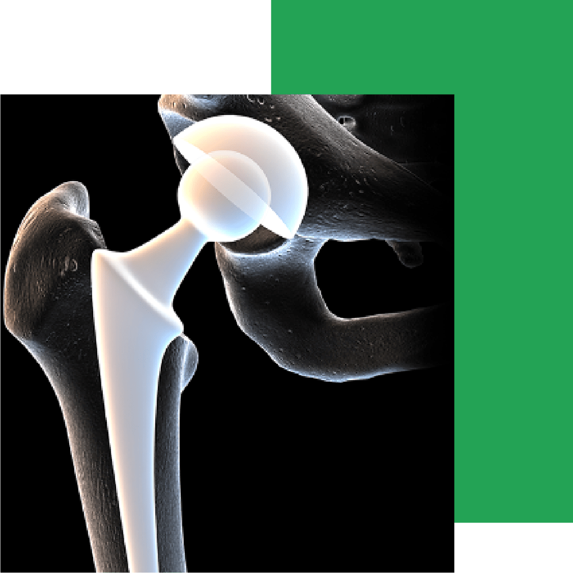 Hip Replacement Surgery Expert Surgeries 8569