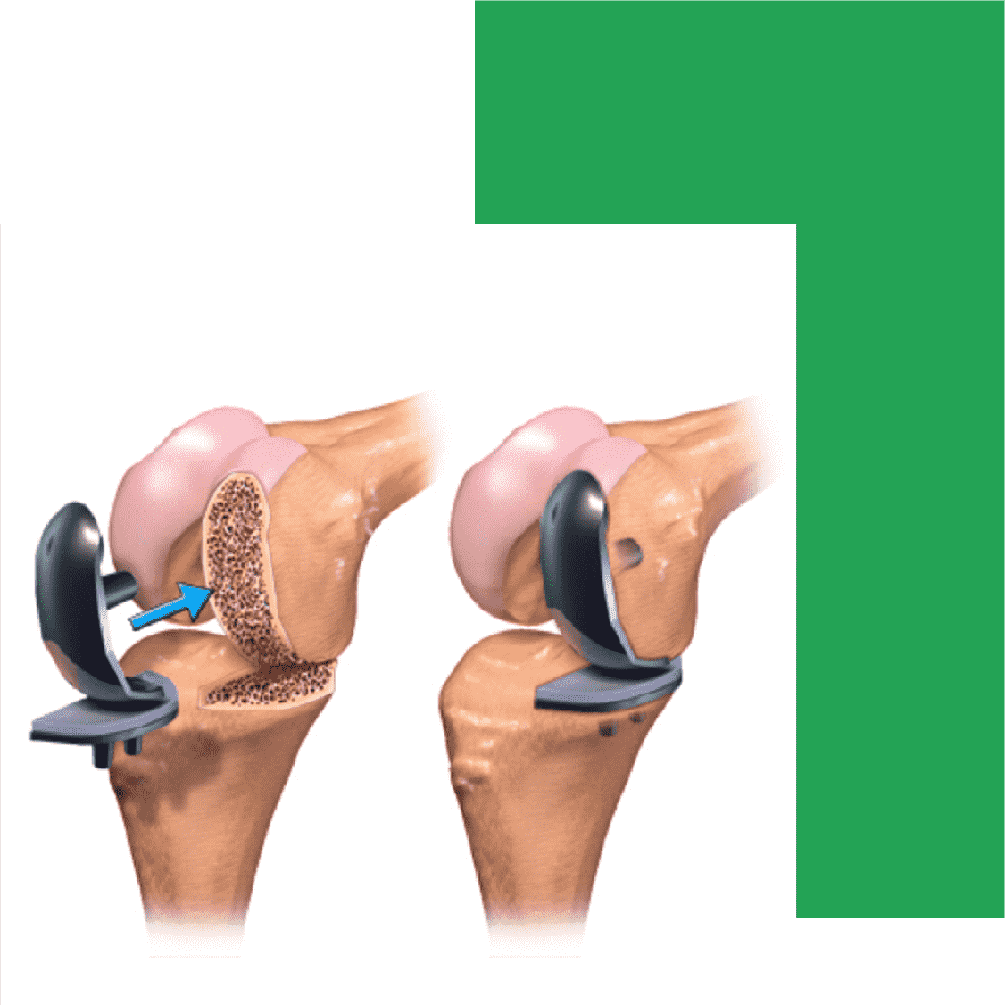 Knee Replacement Surgery Expert Surgeries 4147