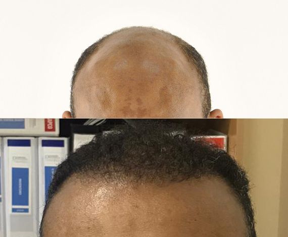 beforeafter-hairtransplant