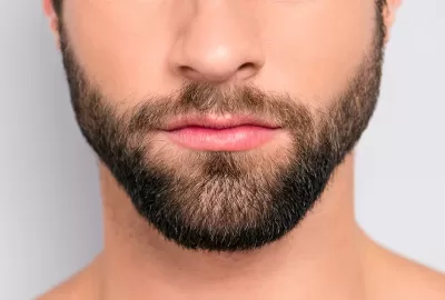 beard-hair-transplant-Vplant-clinic